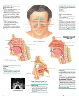 Rinitis y Sinusitis