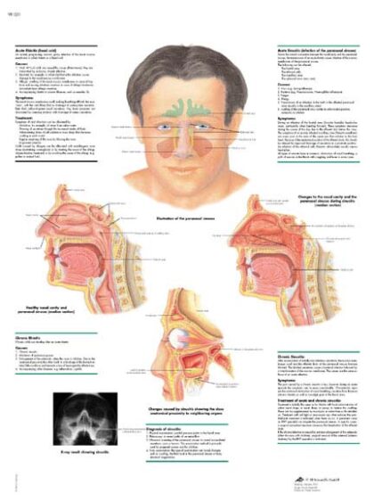 Rinitis y Sinusitis