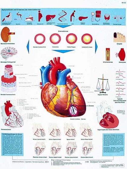 Infarto al Miocardio