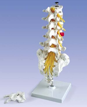 Columna Vertebral Lumbar con Hernia Discal