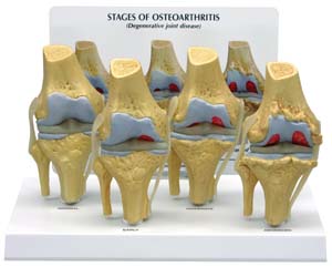 4 Etapas de Osteoartritis de Rodilla