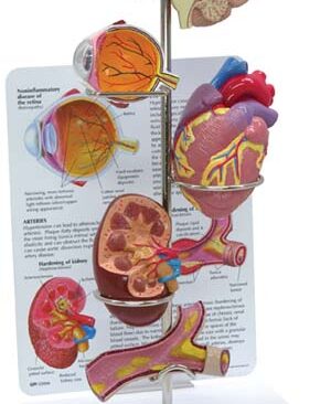 Modelo de Hypertensión