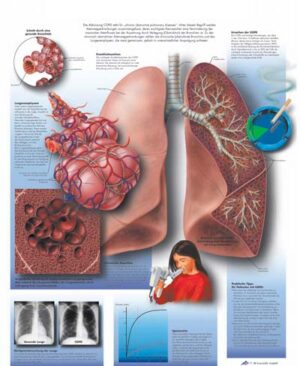 EPOC Enfermedad pulmonar obstructiva crónica