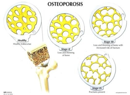 Conjunto de discos – 4 fases de la osteoporosis - Image 2