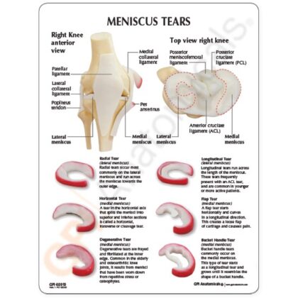 Modelo de rodilla, menisco con 6 desgarros - Image 3