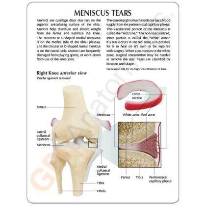 Modelo de rodilla, menisco con 6 desgarros - Image 2