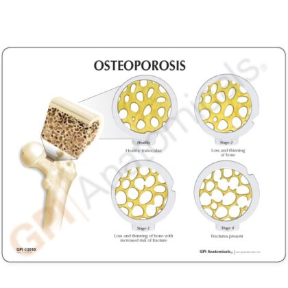 Conjunto de discos – 4 fases de la osteoporosis - Image 3