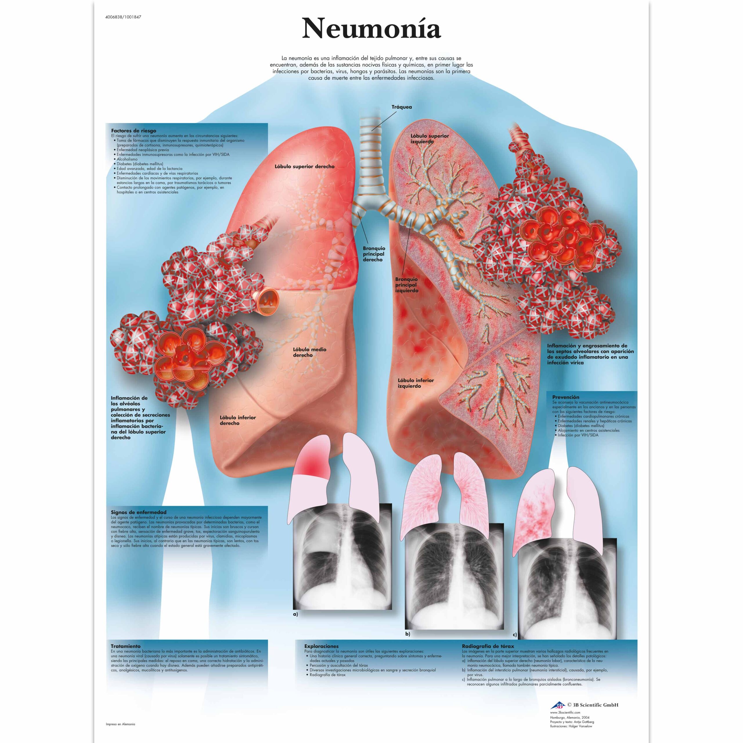 bronconeumonía vs neumonía lobar