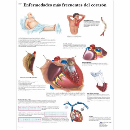 Enfermedades más frecuentes del corazón Lámina